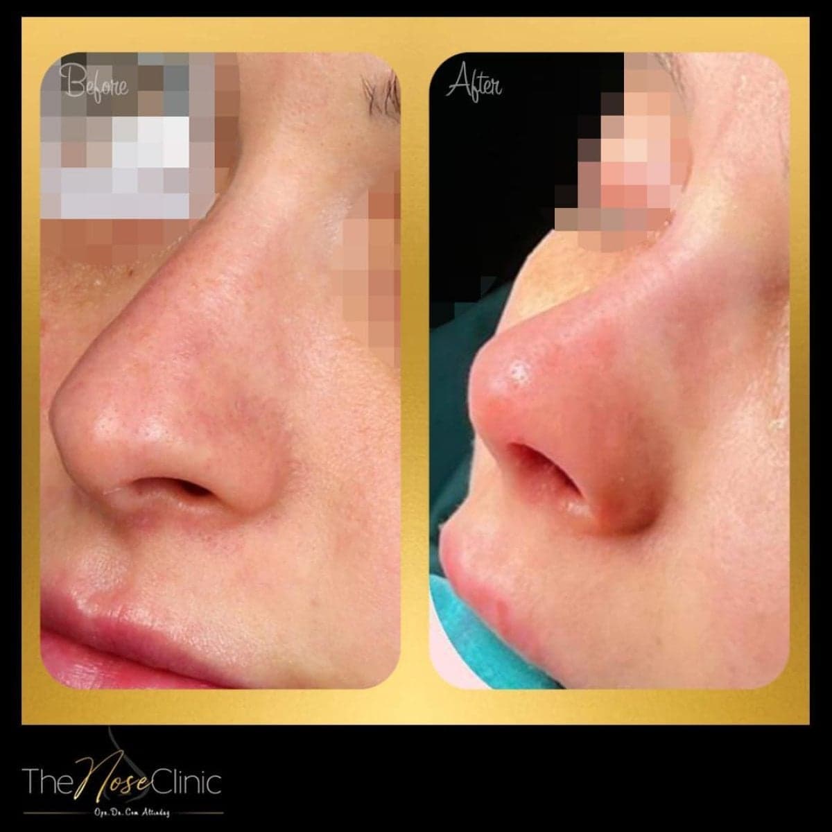 revision rhinoplasty