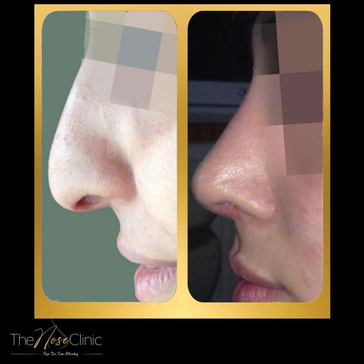rhinoplasty