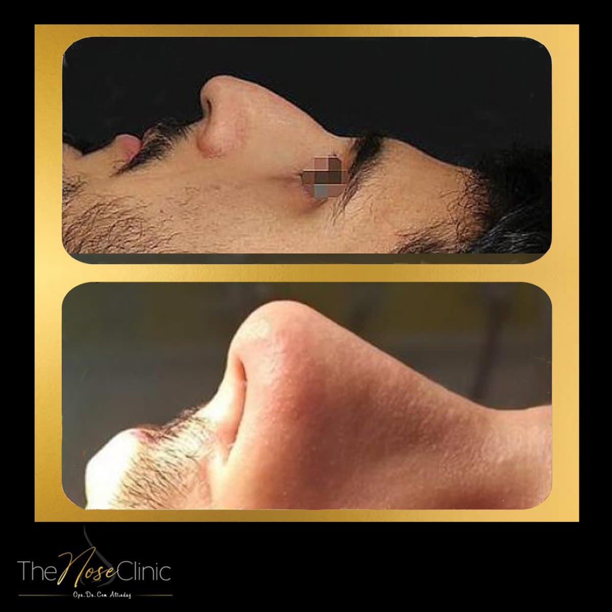 rhinoplasty