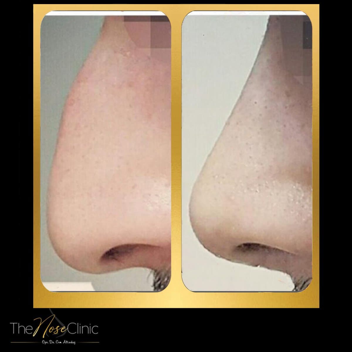 rhinoplasty