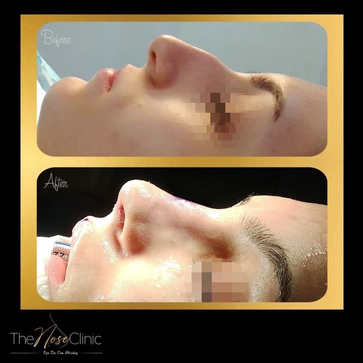septoplasty