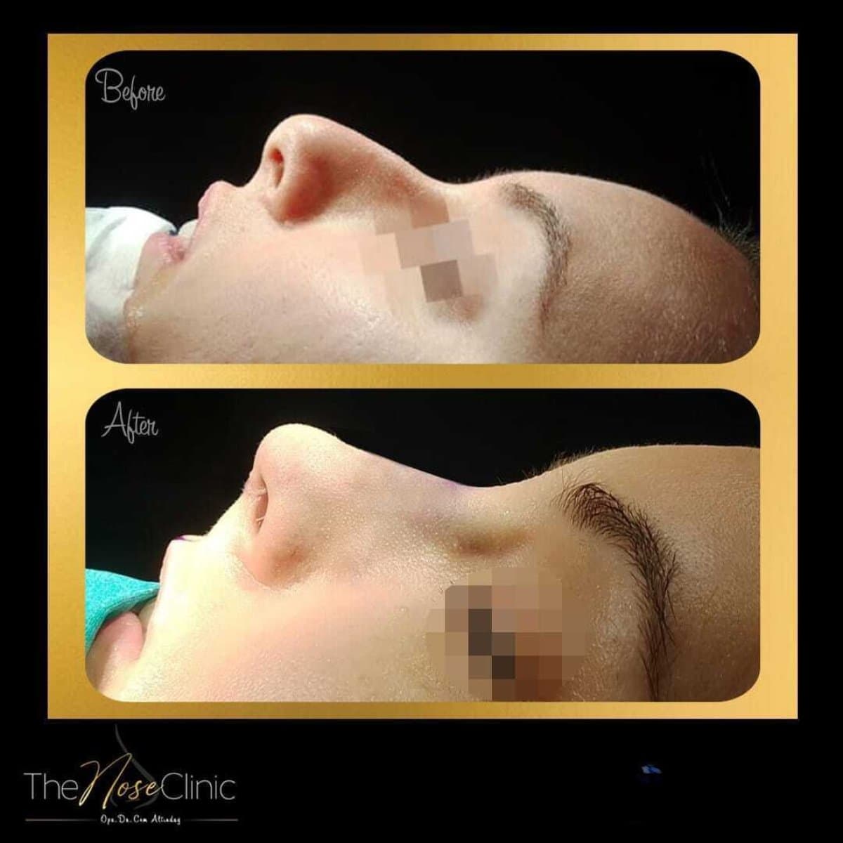rhinoplasty