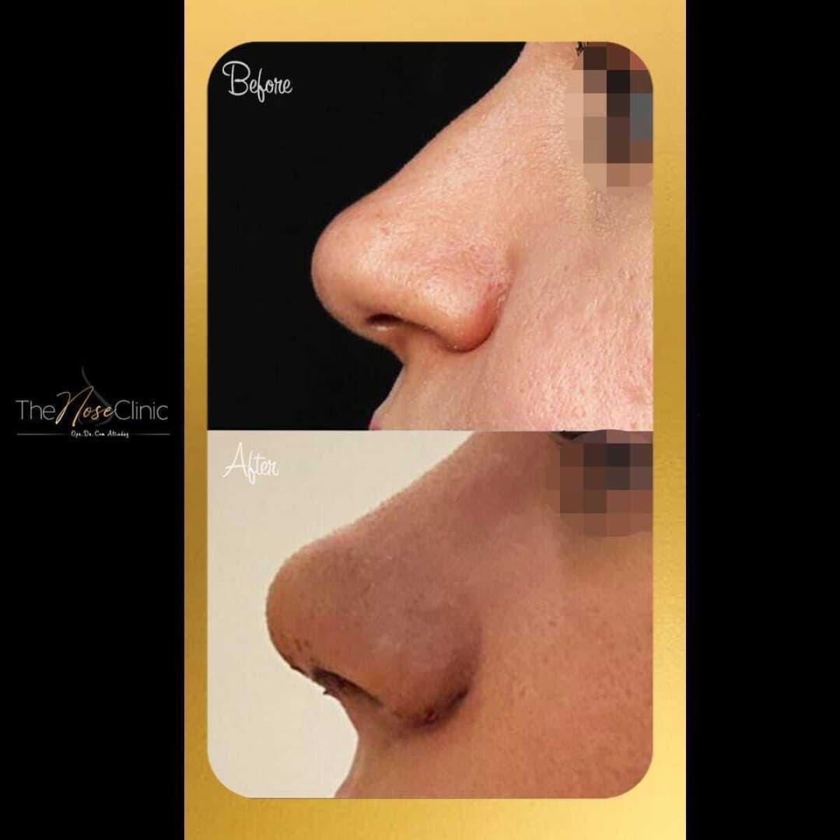 rhinoplasty