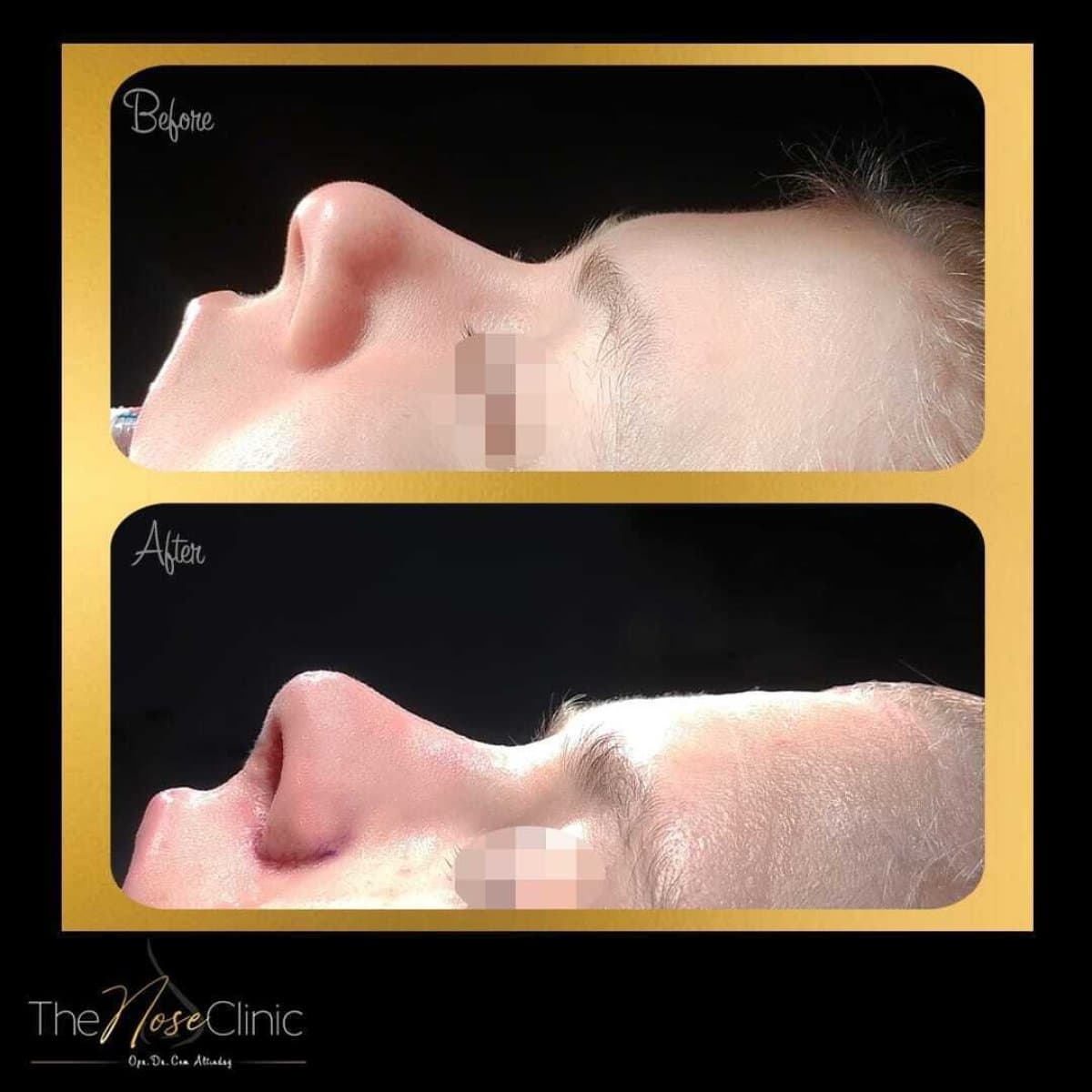 rhinoplasty
