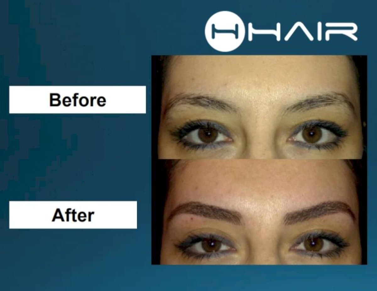 eyebrow transplant