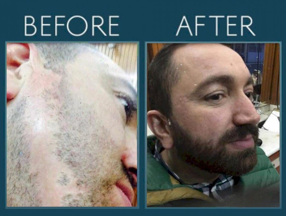 beard transplant