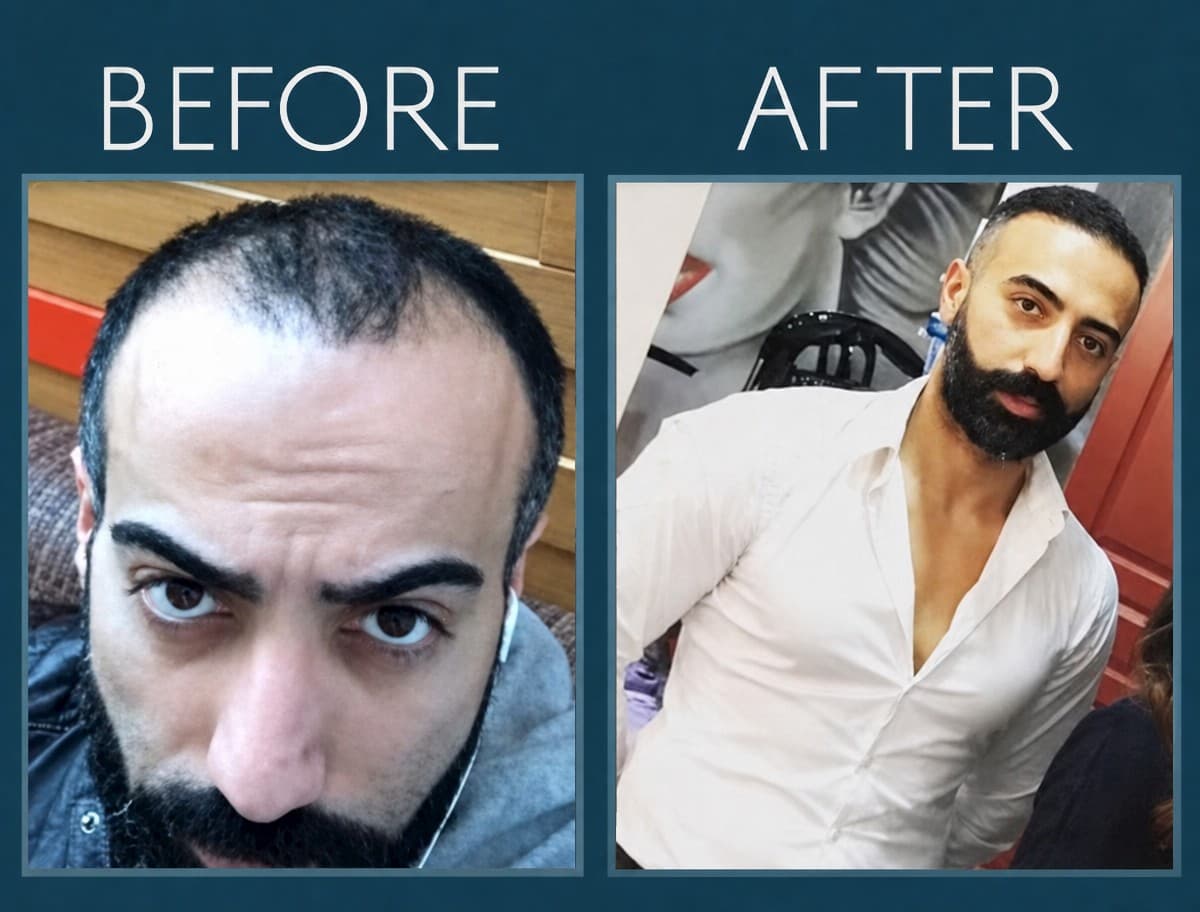 FUE hair transplant