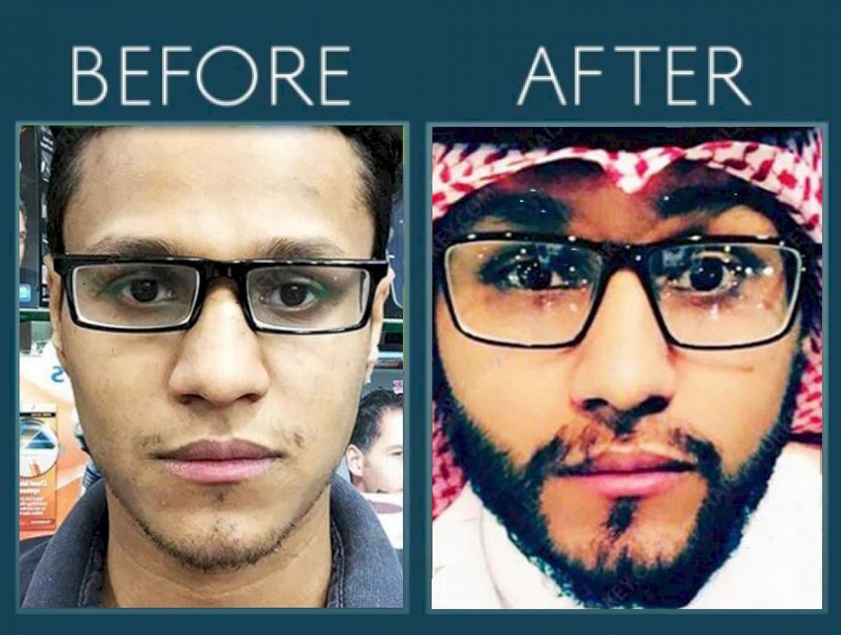 beard transplant