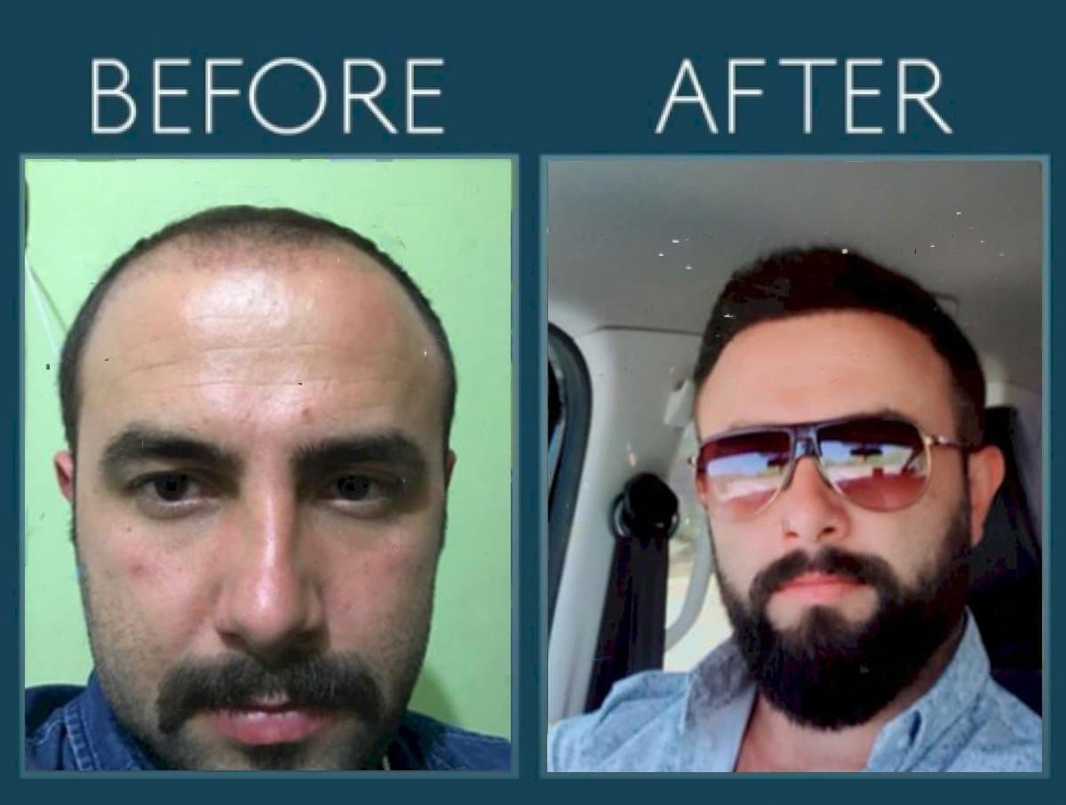 FUE hair transplant