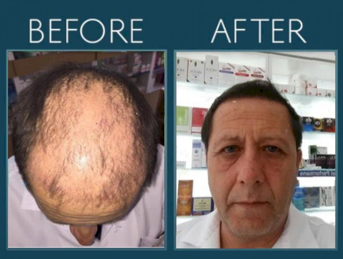 FUE hair transplant