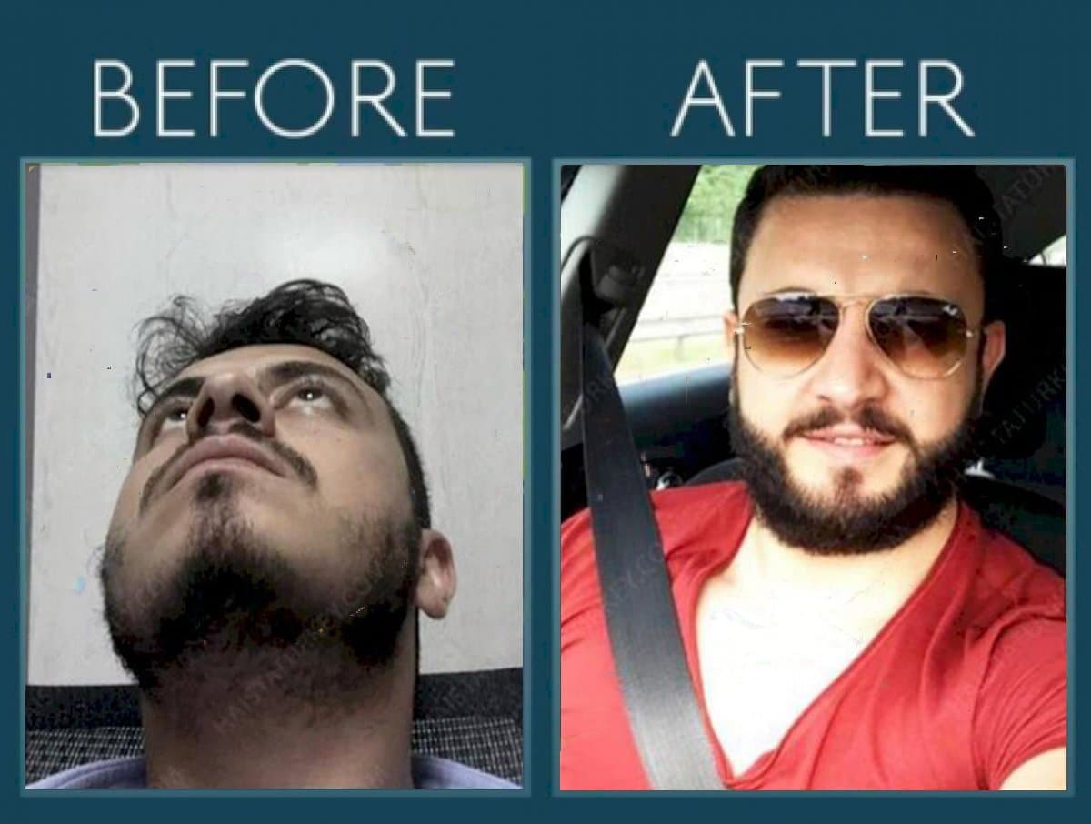 beard transplant