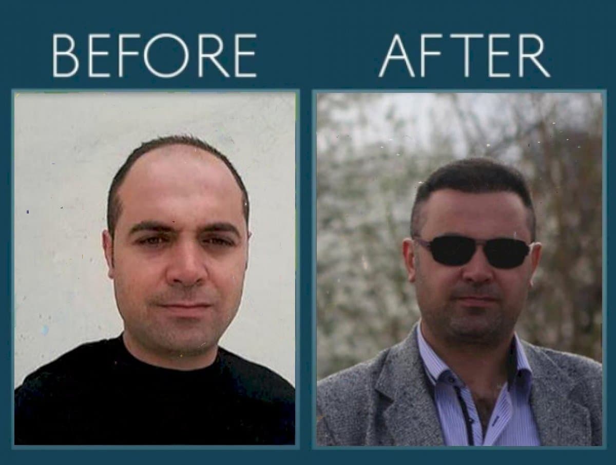 FUE hair transplant