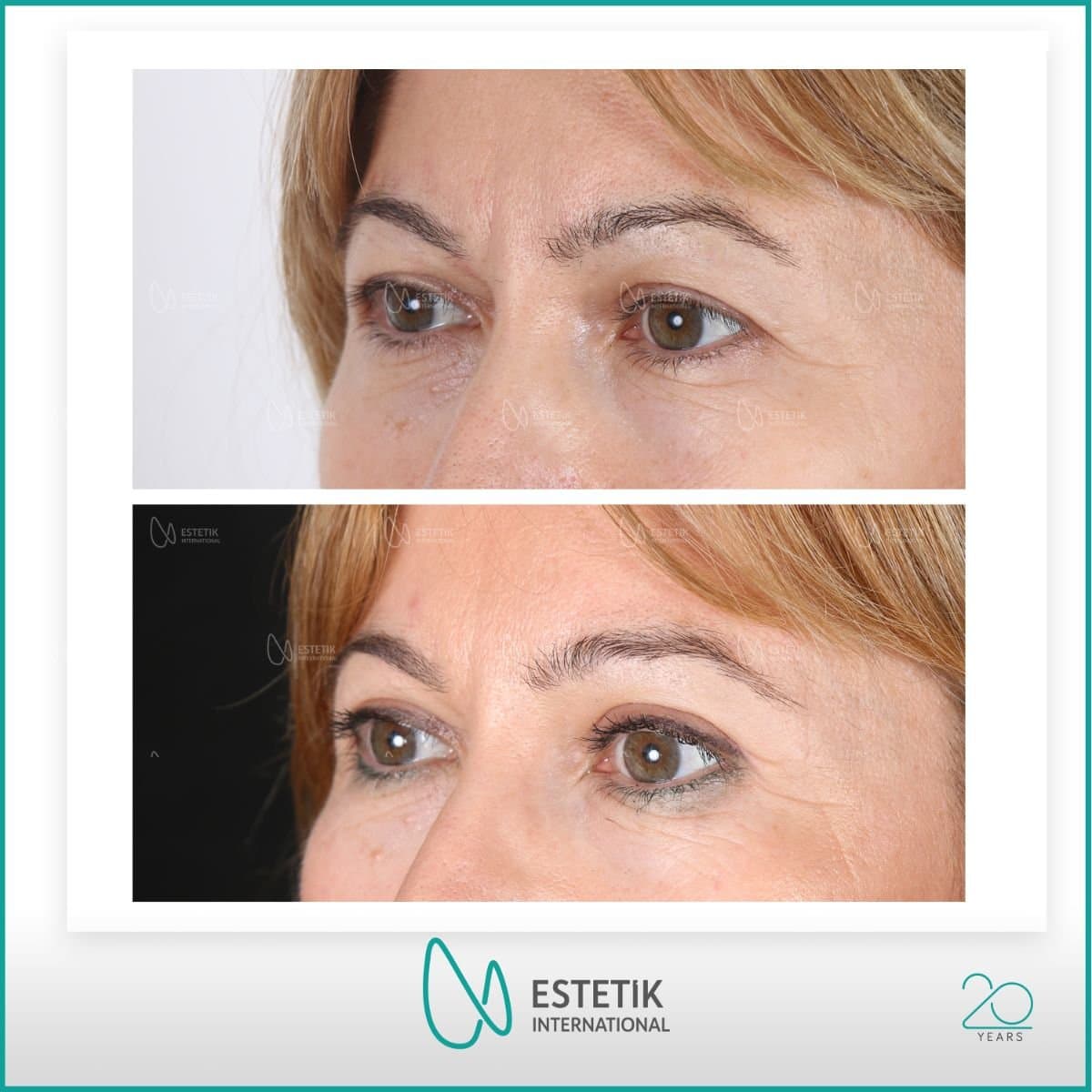 blepharoplasty