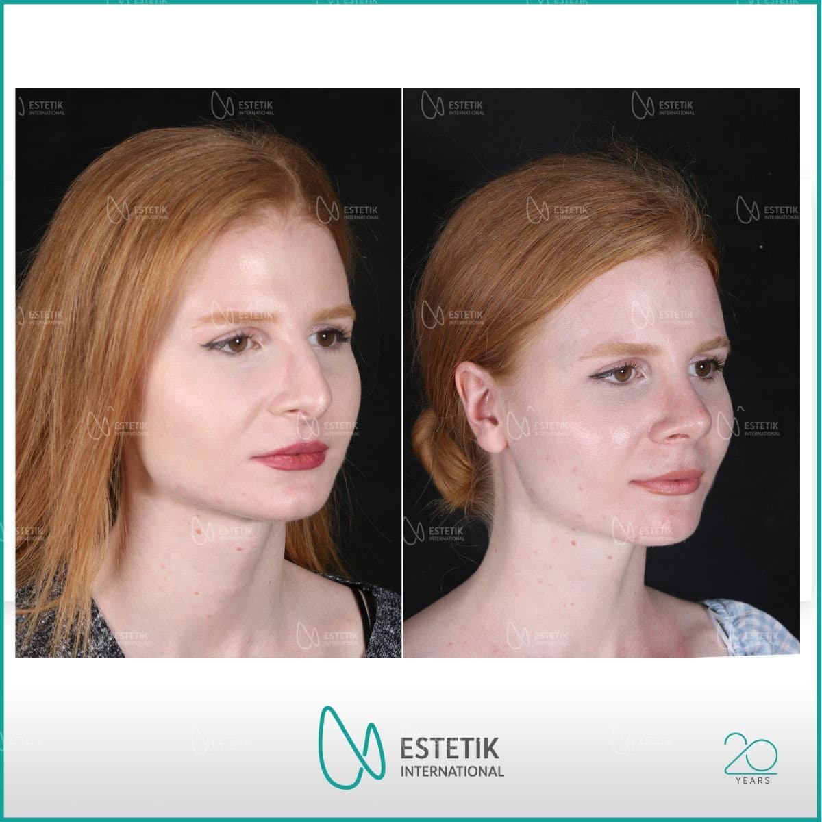 septoplasty