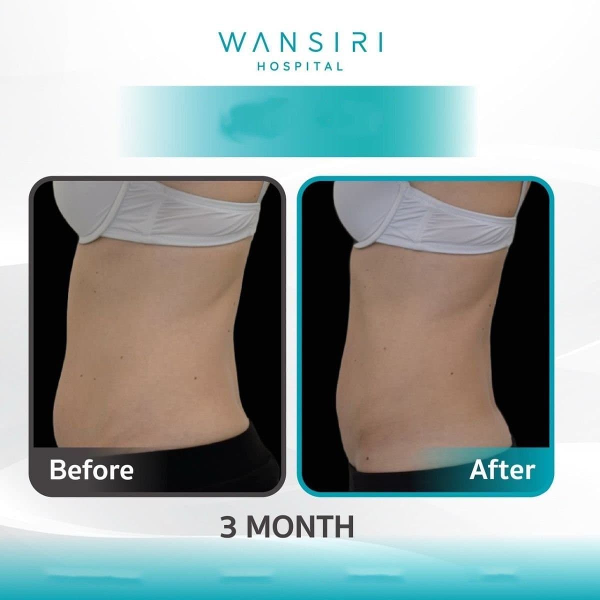 cryolipolysis
