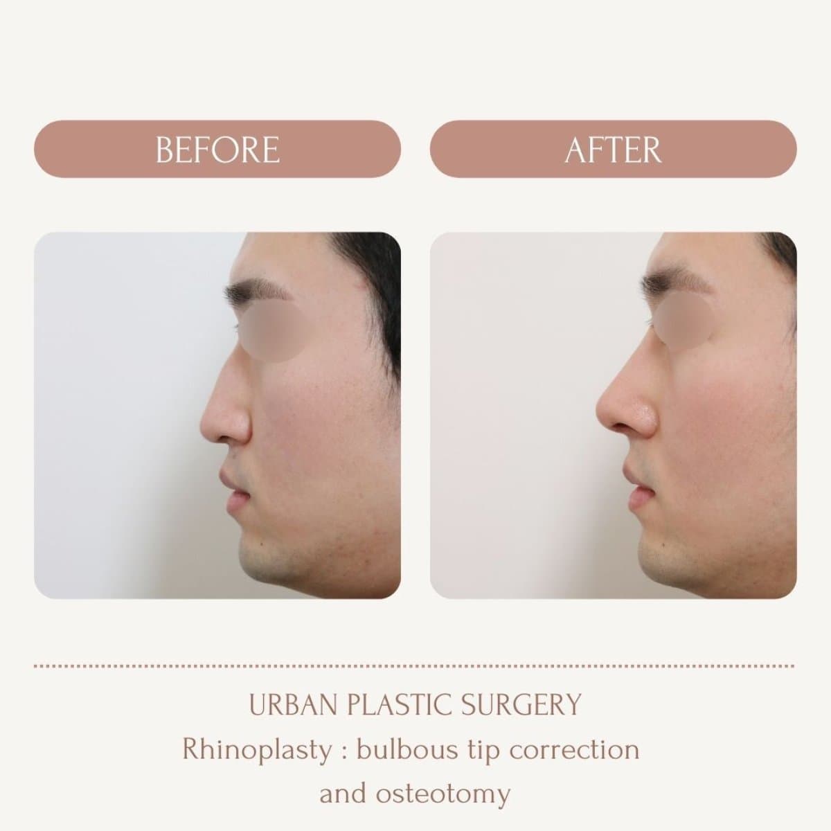 bulbous nose rhinoplasty