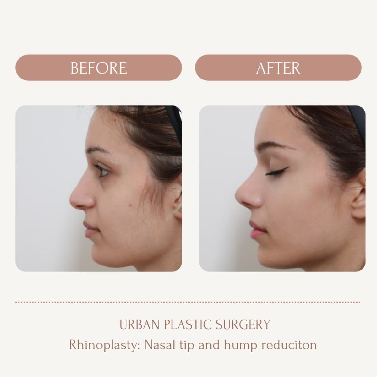 nasal hump removal