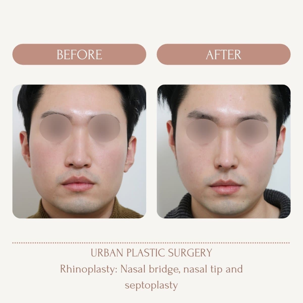 nasal hump removal