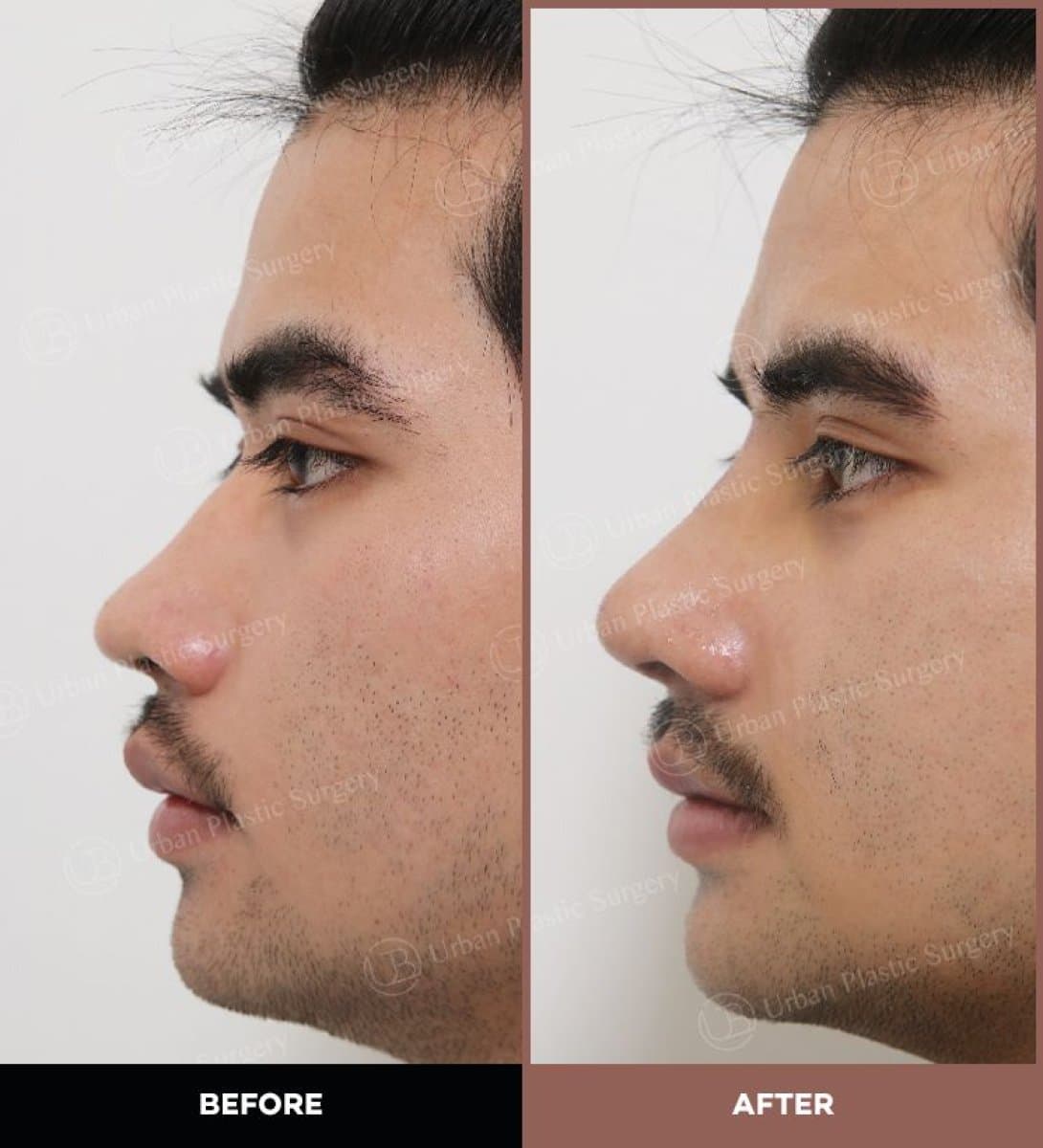 ultrasonic rhinoplasty