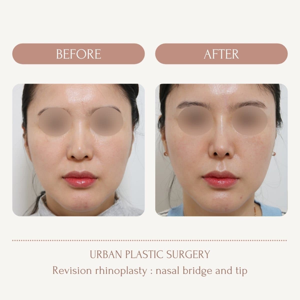 revision rhinoplasty