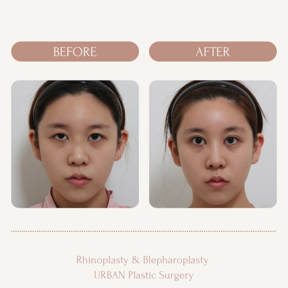 rhinoplasty and blepharoplasty