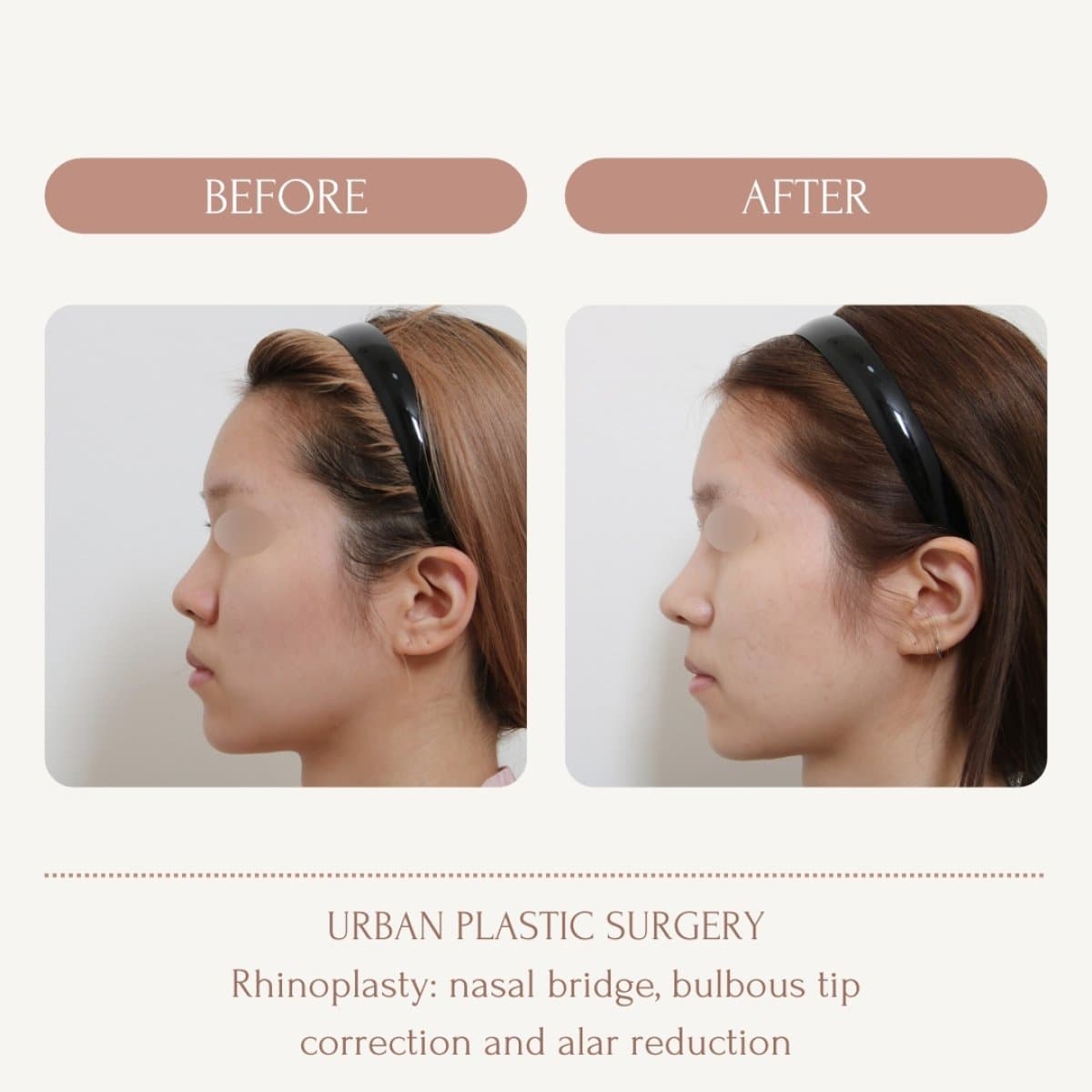 bulbous nose rhinoplasty