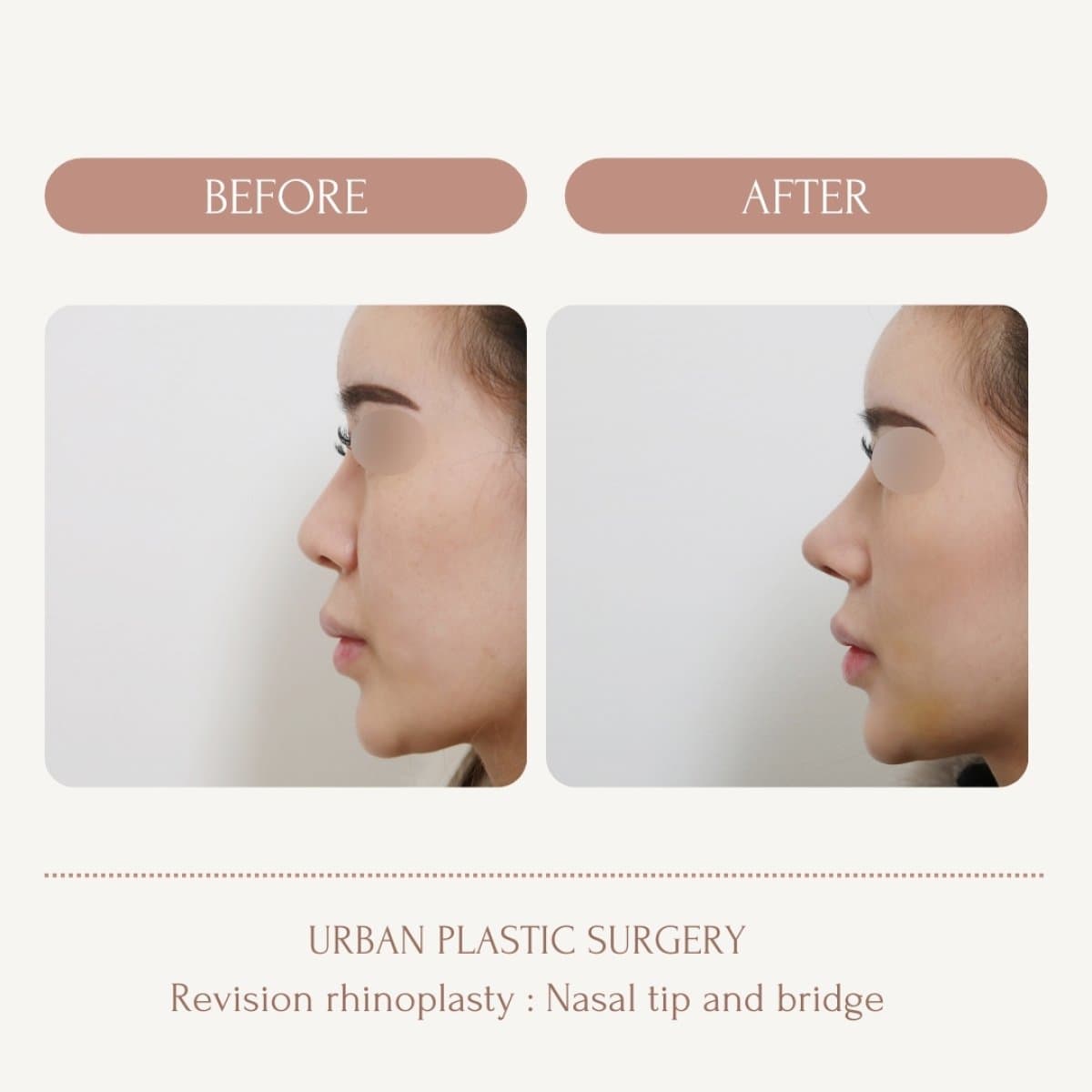 revision rhinoplasty
