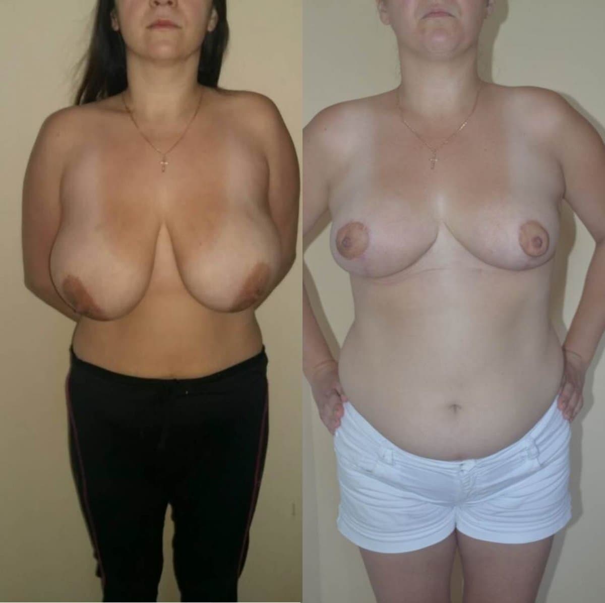 breast reduction