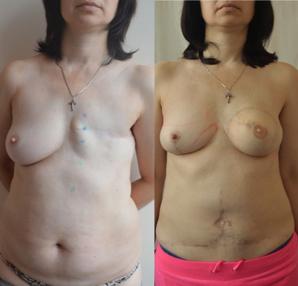 breast reconstruction surgery