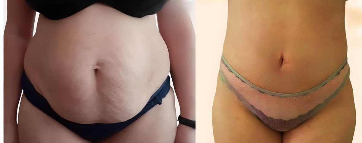 abdominal liposuction