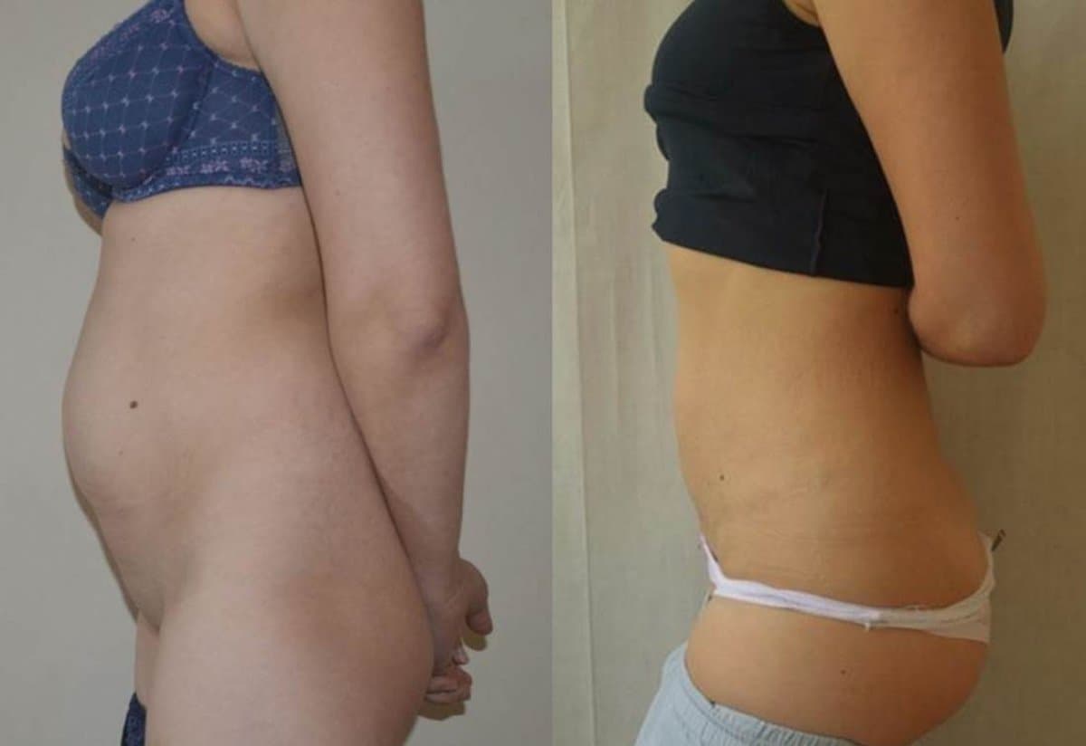 liposuction