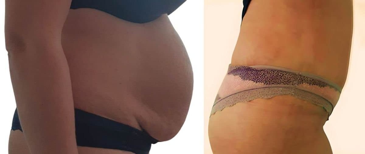 abdominal liposuction