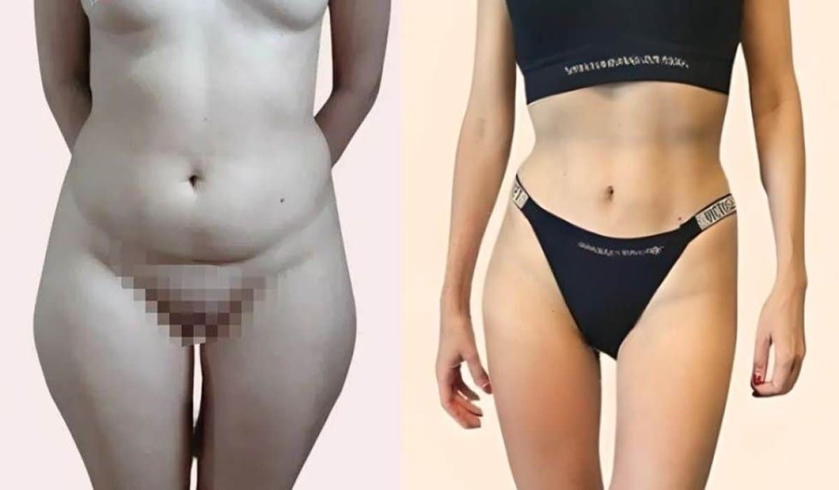 abdominal liposuction