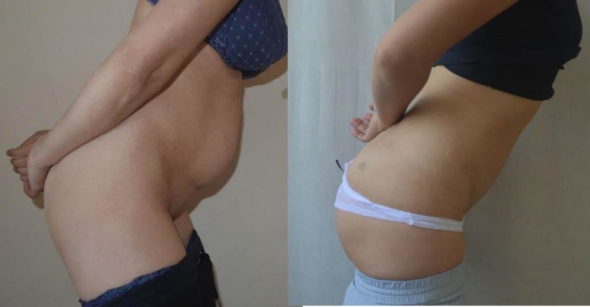 liposuction