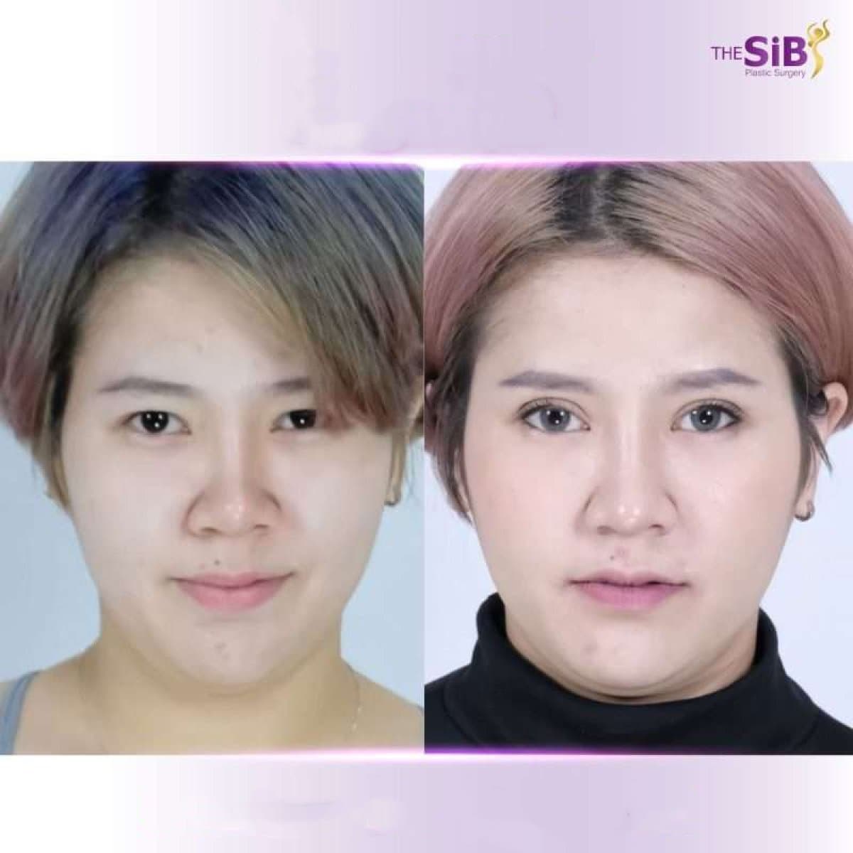blepharoplasty