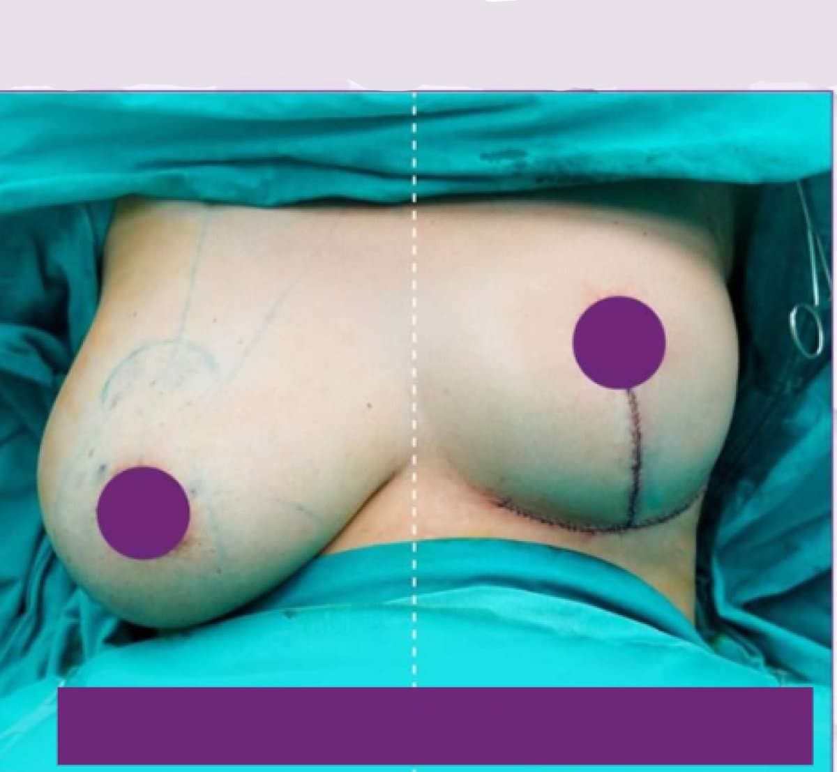 breast lift