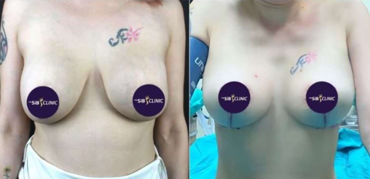 breast lift