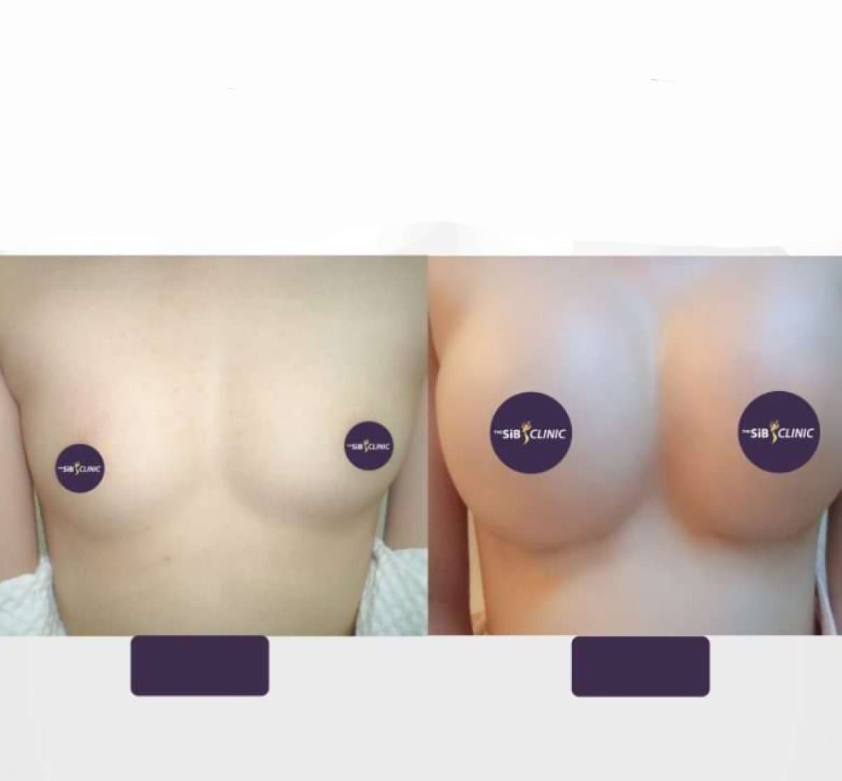 breast augmentation