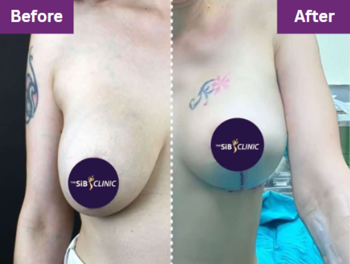 breast lift
