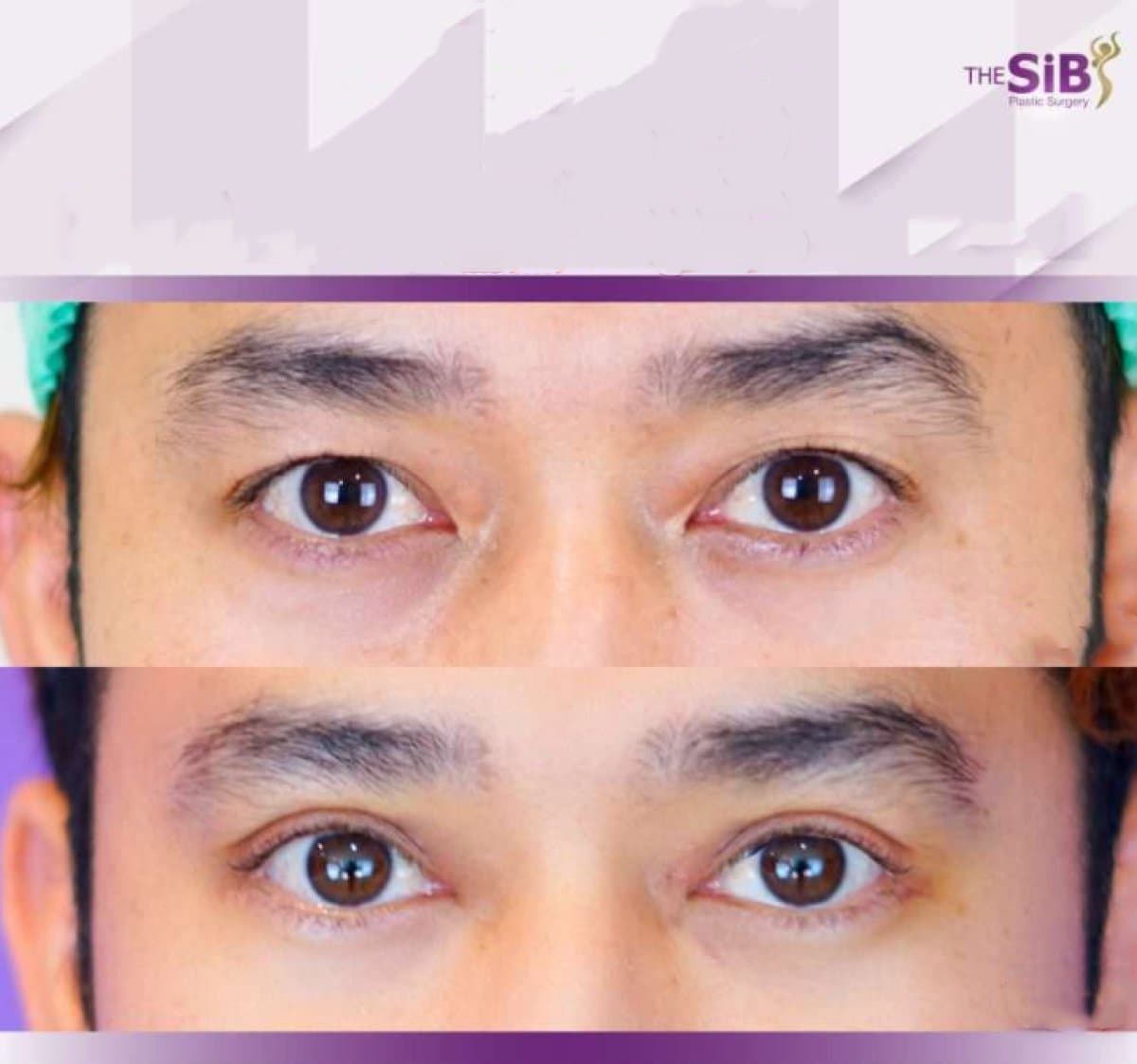 blepharoplasty