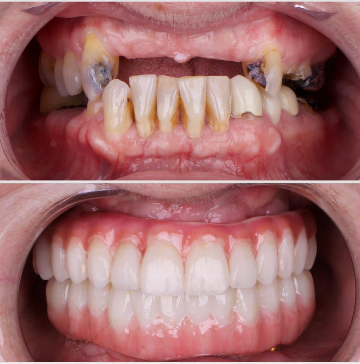 All-on-4 dental implants