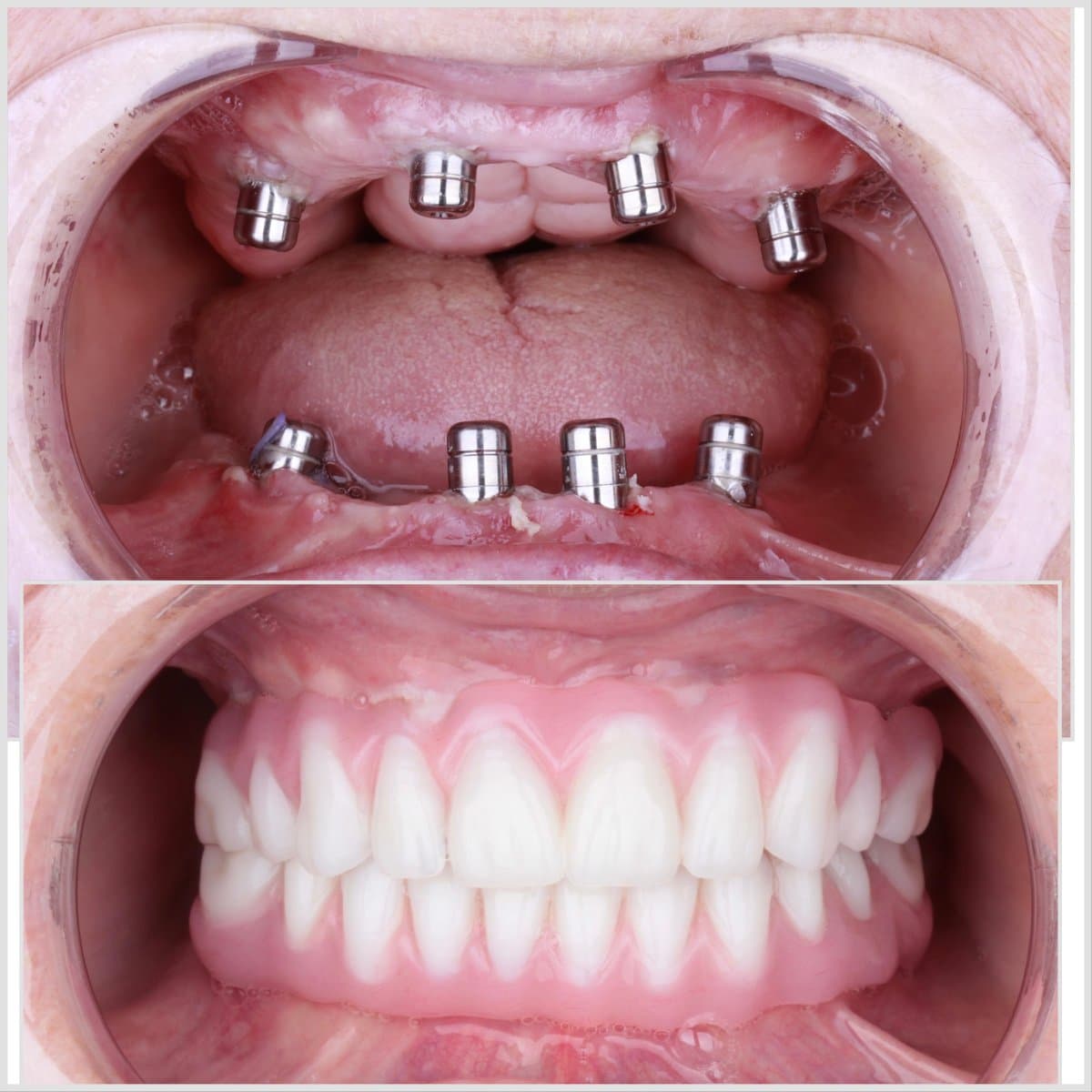 All-on-4 dental implants