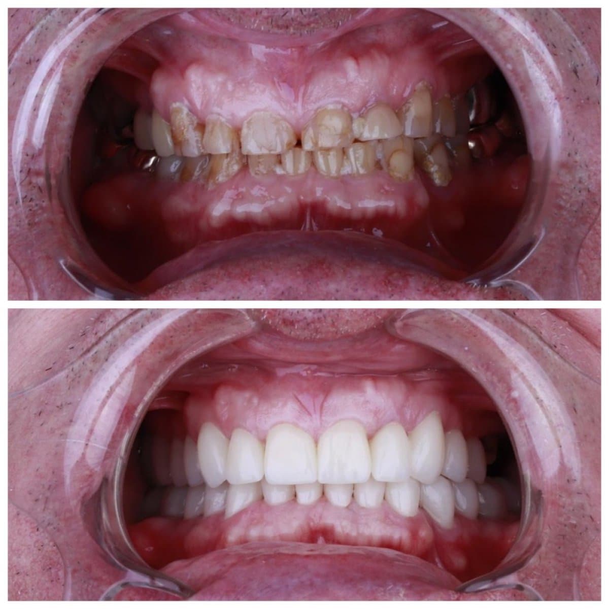 Hollywood Smile