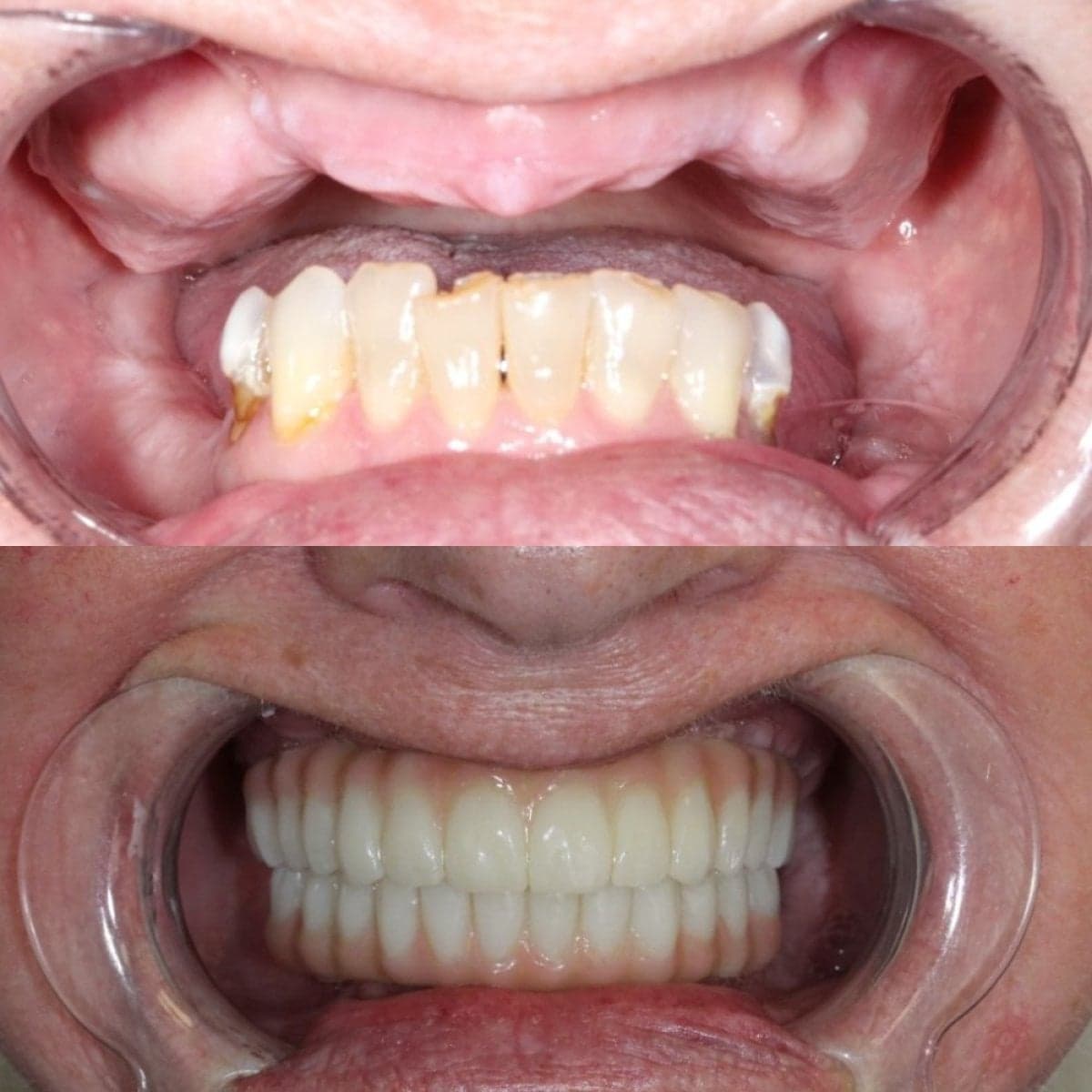 denture