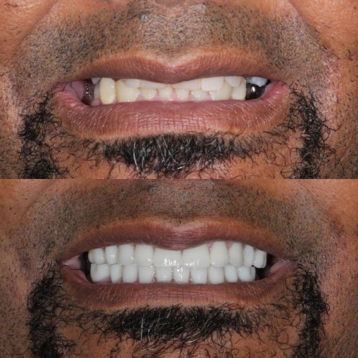 denture