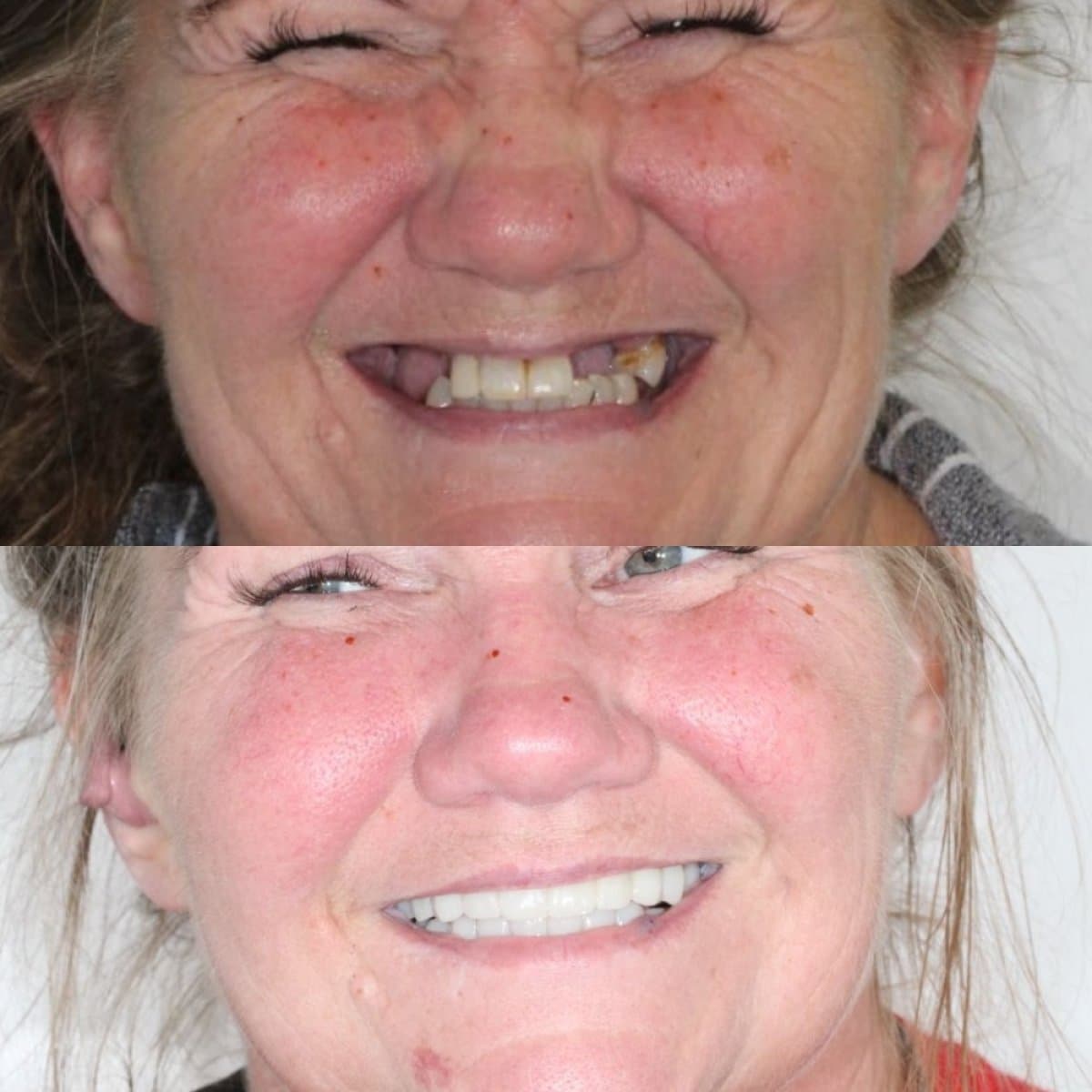 denture