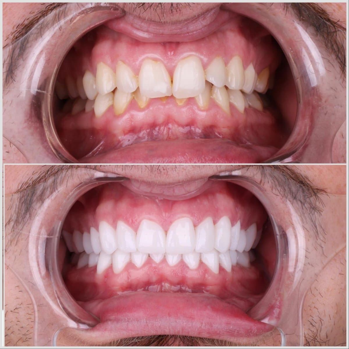 Hollywood Smile