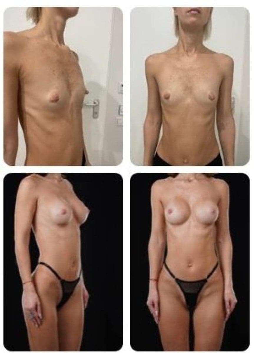 breast augmentation