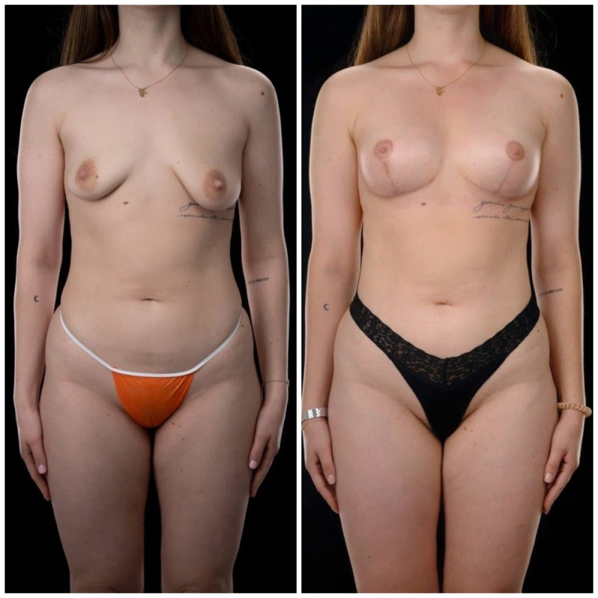 breast augmentation
