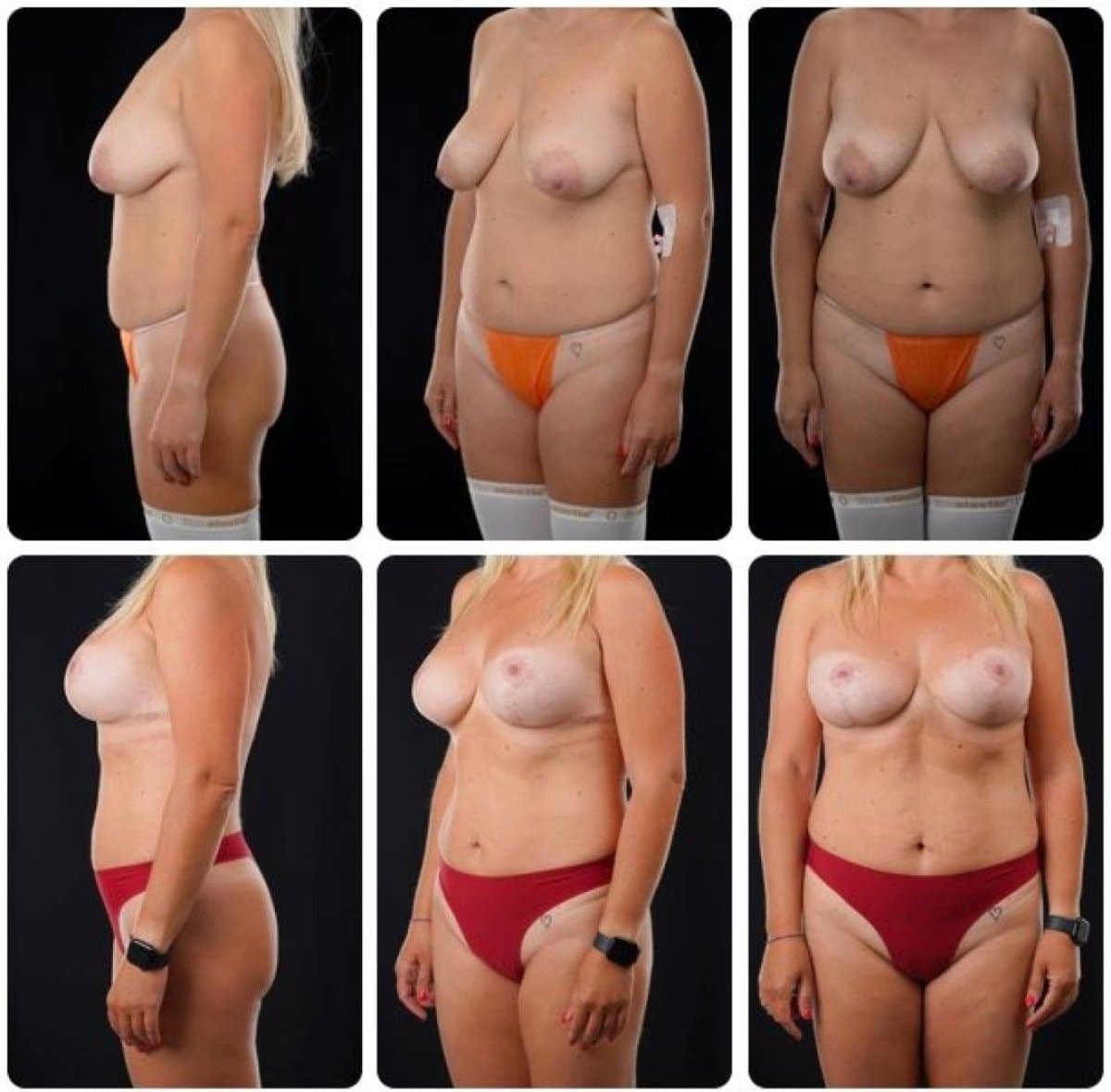 breast lift